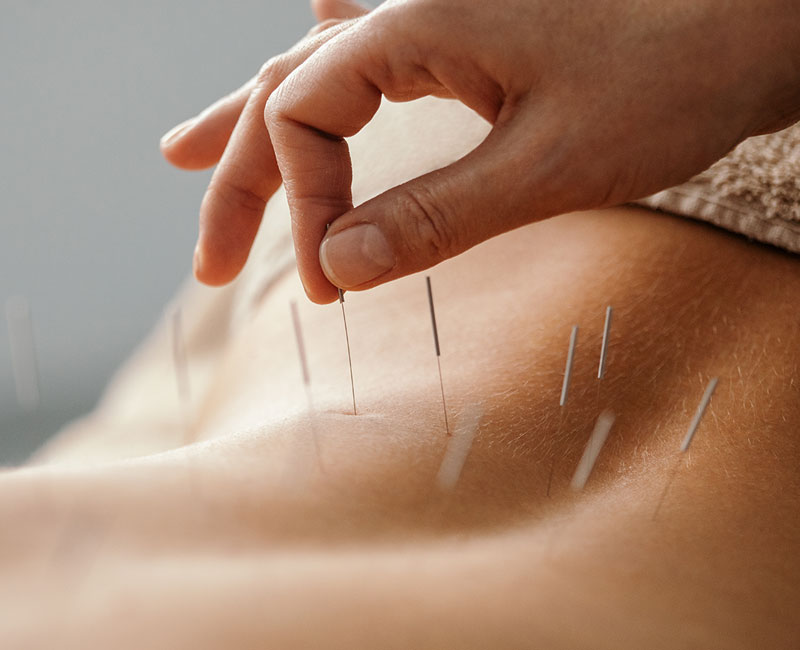 Acupuncture Treatment to Stimulate Energy